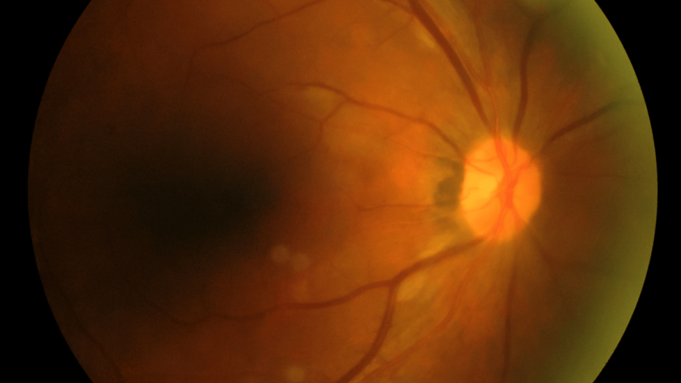 Diabetic Retinopathy How to Protect Your Vision. Eyecare Associates